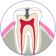 虫歯の進行Ｃ２