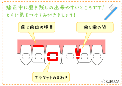 矯正中に磨き残しのできやすいところです