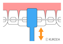 矯正治療中の歯のみがき方