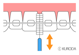 矯正中の歯みがき