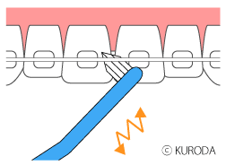 矯正治療中の歯磨き