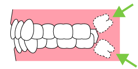 抜歯が必要な親知らず