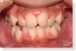 デコボコの歯並び　八重歯