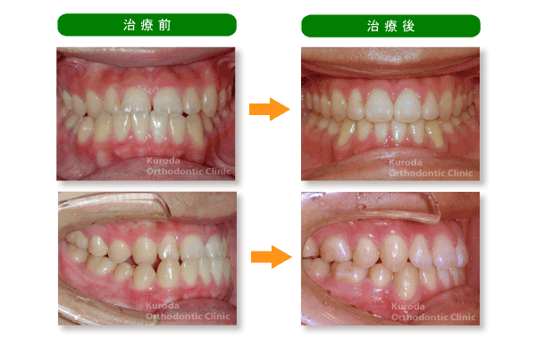 反対咬合・受け口 治療例