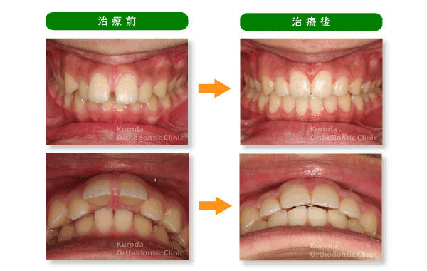 永久歯列の矯正治療例 横浜市青葉区の矯正歯科 あざみ野駅のクロダ矯正歯科