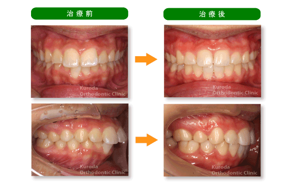 上下顎前突・口もとが出ている 治療例