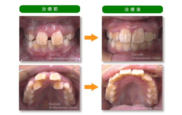 混合歯列　叢生