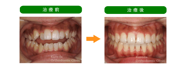 開咬・歯が噛まない 治療例