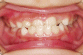 口腔内写真　歯の写真