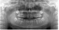 歯のレントゲン