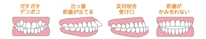 不正咬合の種類